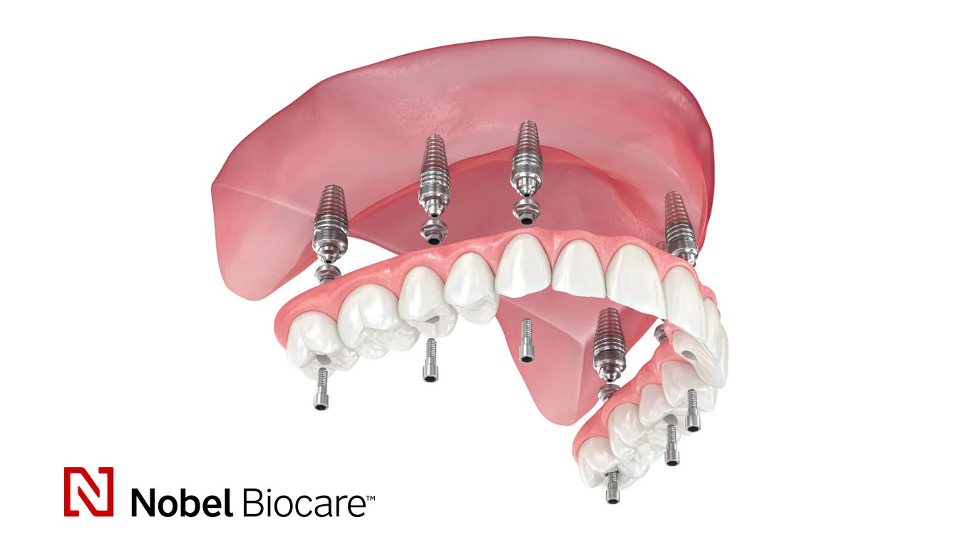 Ilustrație 3D All-on-6 — arcadă pe șase implanturi cu lucrare provizorie înșurubată, sistem Nobel Biocare (imagine editorială)