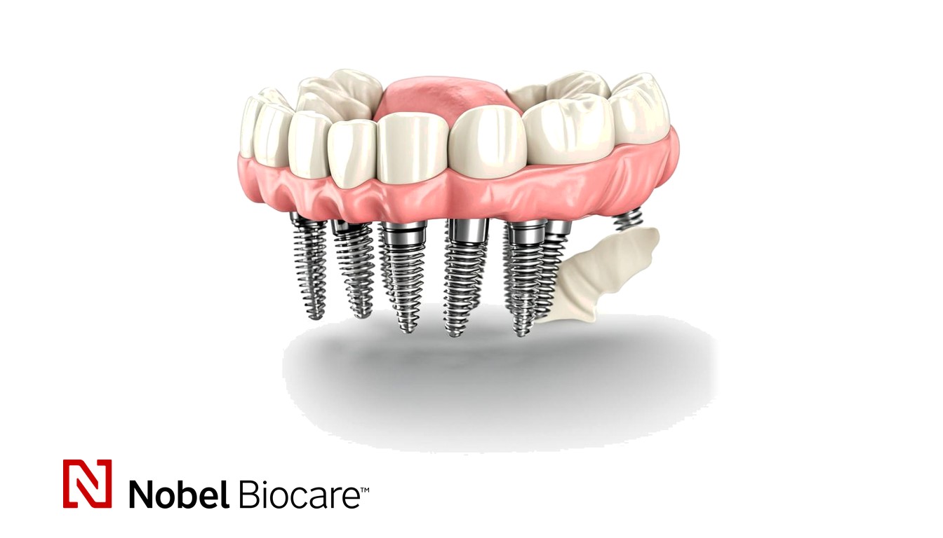 Lucrare definitivă pe implanturi — zirconiu pe bară de titan, 12 elemente, sistem Nobel Biocare (imagine editorială)